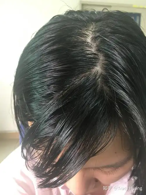 头发爱出油,有什么好的解决办法吗?