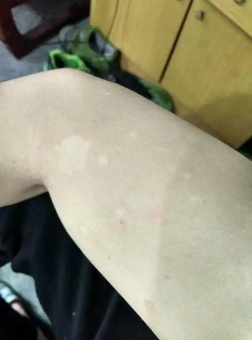 这是什么皮肤病,手臂上掉皮后变成白色,后背长的红红小点,不痛不痒