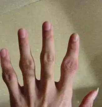 手指关节肿大是怎么回事