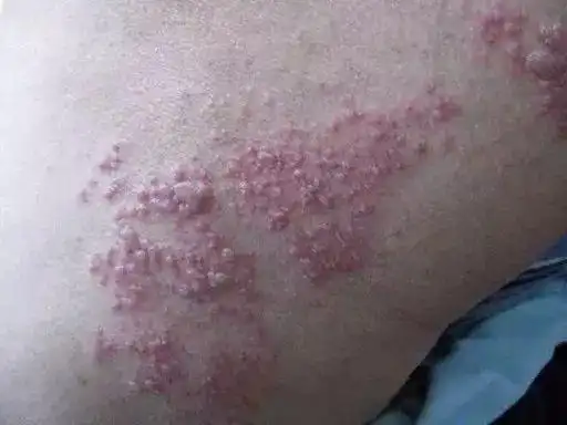 警惕这种病最近高发可传染严重会失明浙江竟有人纹身治病