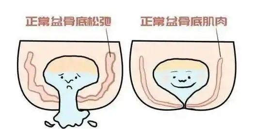 膨出,脱垂,尿失禁,产后受伤的盆底肌该如何快速恢复?