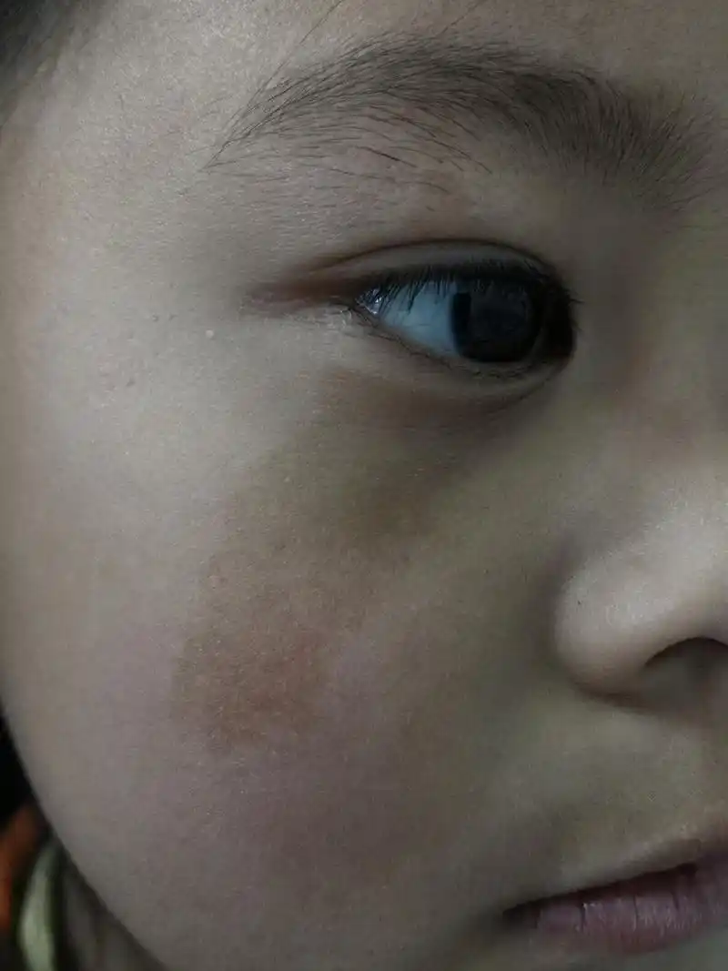 儿童一侧面颊部位的黄褐色斑片.考虑咖啡斑.可以手术切除治疗.激光治