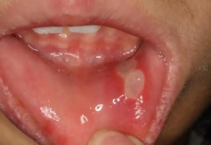 【科普】口腔健康科普宣传知识问答——(十一)关于口腔溃疡的常见问题