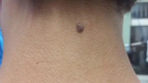 扁平,色素深,好发手足,可因外伤磨损感染等恶变)混合痣(位于表皮基层