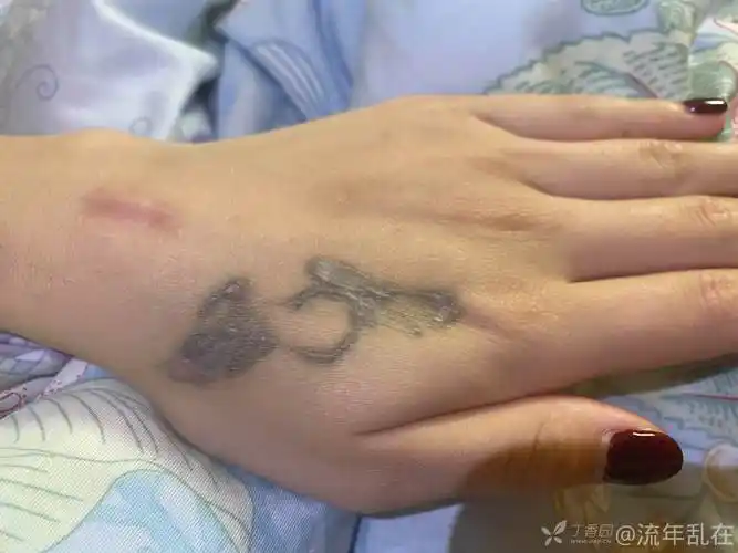 求左手虎口纹身切除设计