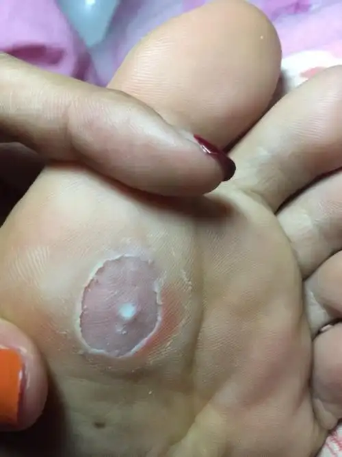 贴了鸡眼贴,今晚把表皮剪了,鸡眼那个白色的掉了一块.但是还有.怎