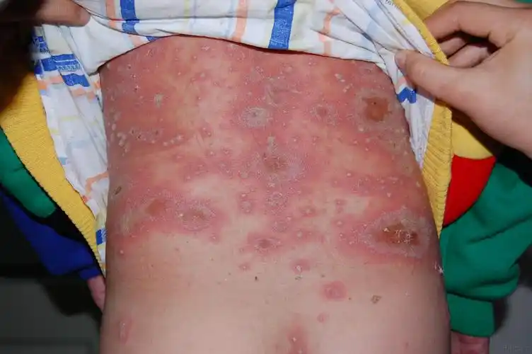 弥漫性脓疱病求助!