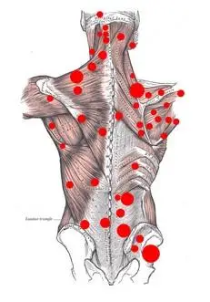 腰背部肌筋膜炎有哪些常见表现?-沈阳东澳疼痛专科