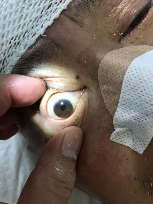 脑梗死溶栓后出血,双侧瞳孔散大,呼吸衰竭,系列救治措施,病人命不该绝