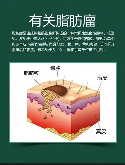 脂肪瘤消贴皮下脂肪瘤多发性单发性硬块脂肪粒消贴 1盒6贴装 一盒6贴