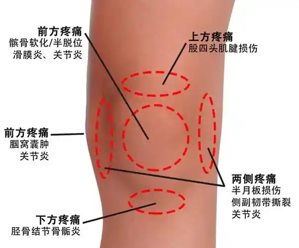 膝关节疼痛自检