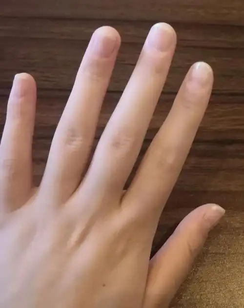 养甲床长达八个月70