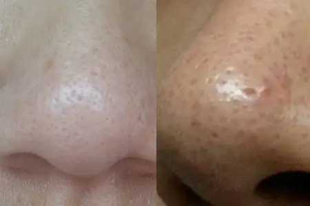 【图】草莓鼻和酒糟鼻的区别是什么 小心草莓鼻影响了你的爱情