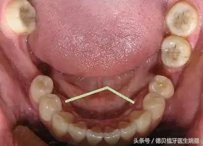 牙槽骨骨质增生该怎么办?