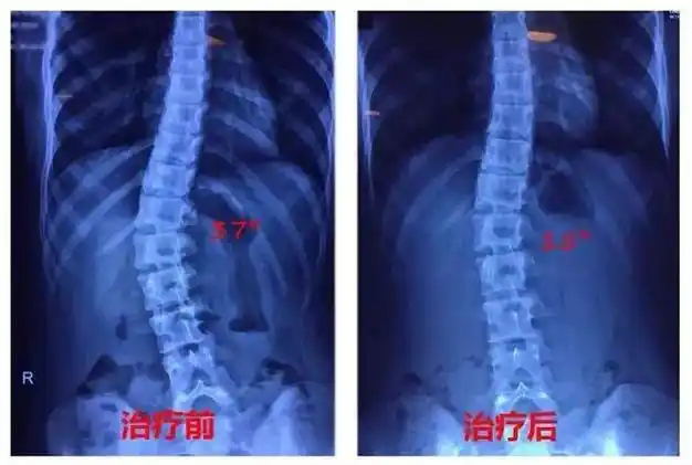肌肉|腰椎|胸椎|脊椎侧弯_网易订阅