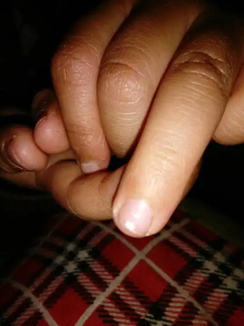 小孩手指尖有点白点是什么原因