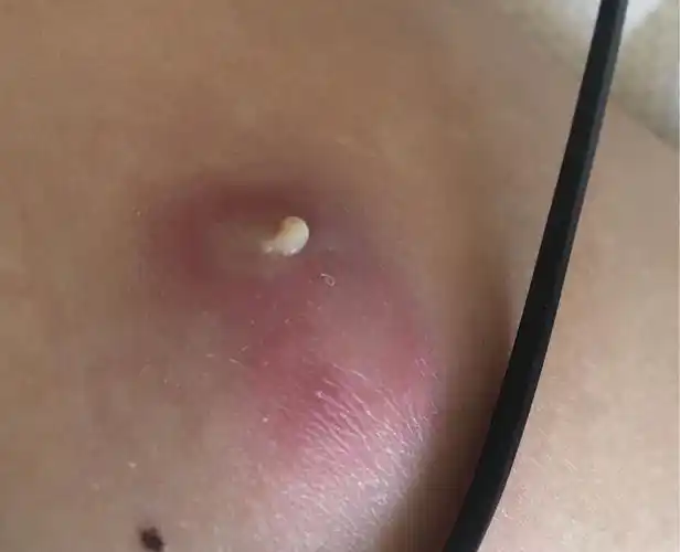 皮脂腺囊肿切除经历到底有多痛