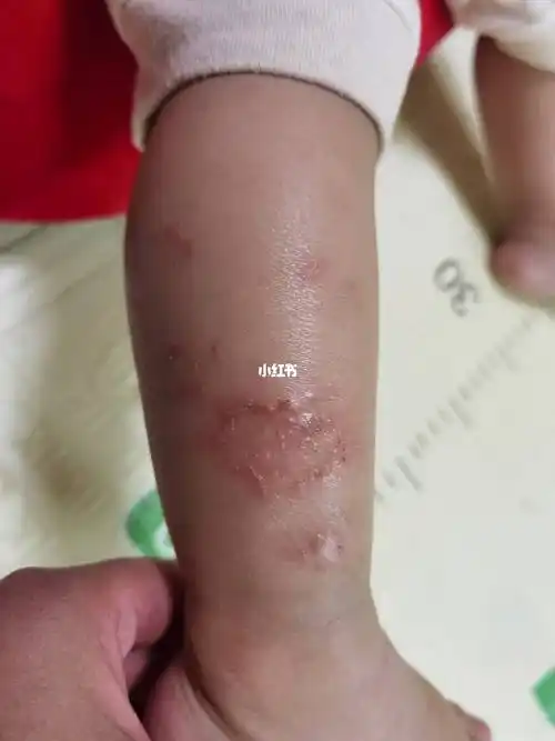 生于面部和头部,然后逐渐向全身扩散,表现出红斑丘疹鳞屑等皮损症状