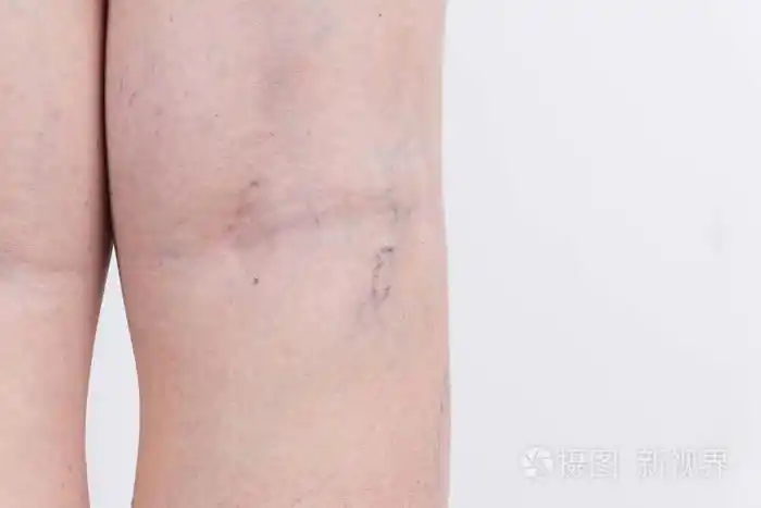 女人腿上的静脉曲张