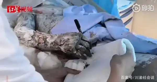 炸鸡店爆炸,男子全身焦黑溃烂颤抖写下:儿子全力救妈,我无所谓