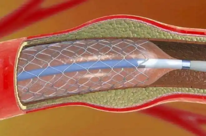 从13000元骤降至700元看国产心脏支架如何吊打国外