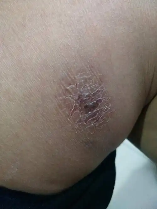 麻烦皮肤科医生帮忙看下 腿上刚开始是红色变成紫色的现在开裂了怎么