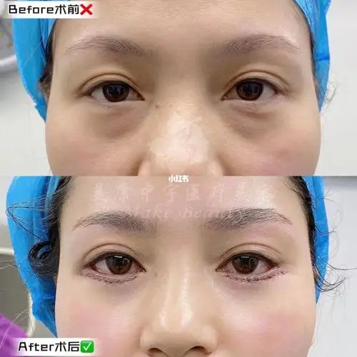 外切眼袋_眼袋_郑州自由行热门攻略_郑州_眼霜_紧致_rose_祛眼袋_美妆