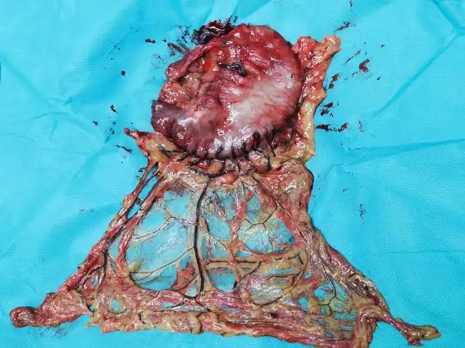 03.20今日两台腹腔镜下全胃切除术