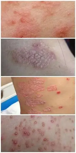 春节后看皮肤病出现热潮,过年期间的饮食极易引发皮肤病! - 美篇