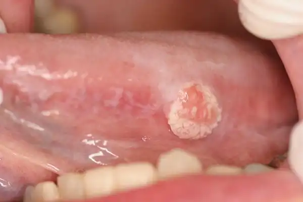 舌癌的初早期症状图片 (51)