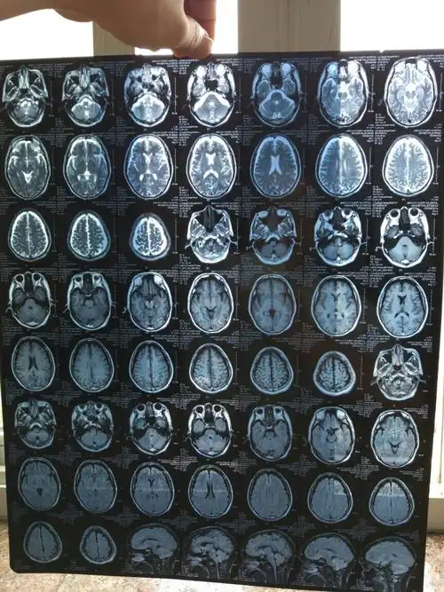 61岁车祸撞击到头部ct显示有脑积水轻微脑萎缩,现在摇头刷牙会头痛没