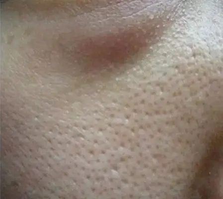 橘皮样皮肤图片45