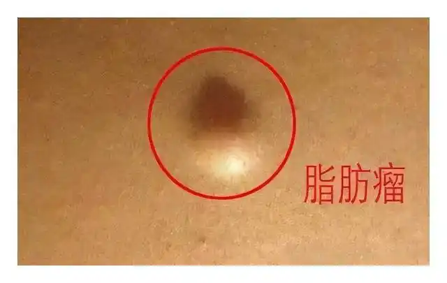 瘢痕疙瘩是一种生长超过伤口边界的疤痕组织肿块,又称结缔组织增生症