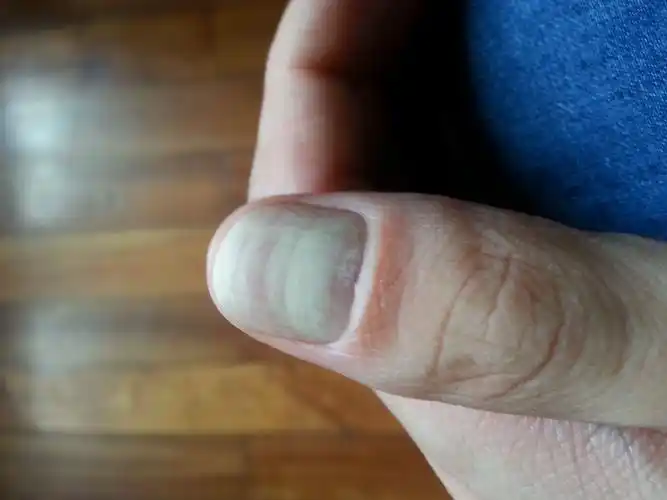 急,拇指指甲发白是什么情况