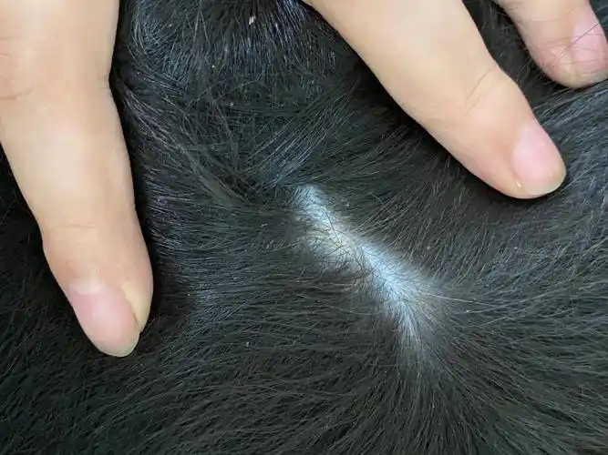 皮肤看起来也没破溃回来滴了黄金点,但还是很多皮屑,跟疙瘩似的点状