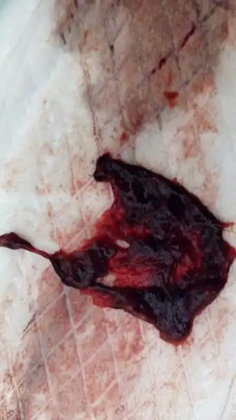 子宫内膜脱落这么多正常吗.