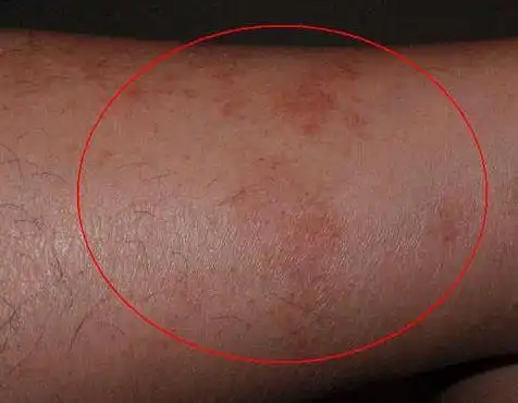 湿疹为什么屡治屡犯反复的原因是