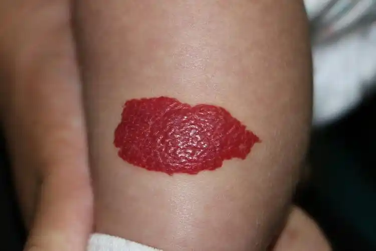 红色胎记知多少:血管瘤?血管畸形?_治疗