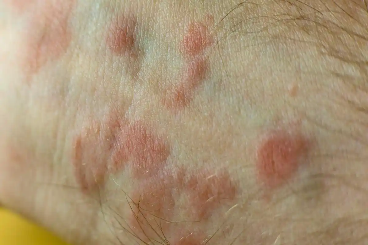 硬下疳最晚几周出现	一般情况下,硬下疳最晚在4周出现.硬下疳是原发梅