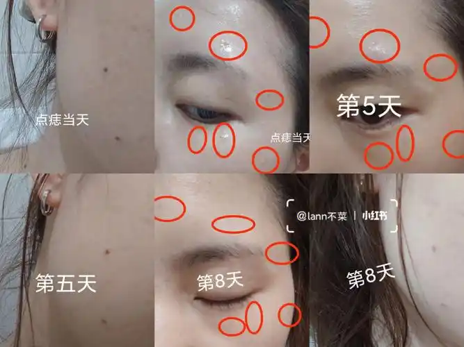 冬天 美容院 激光 点痣分享