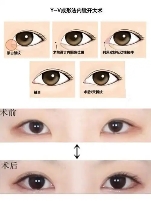 要了解开内眼角手术,首先要了解什么是内眦赘皮