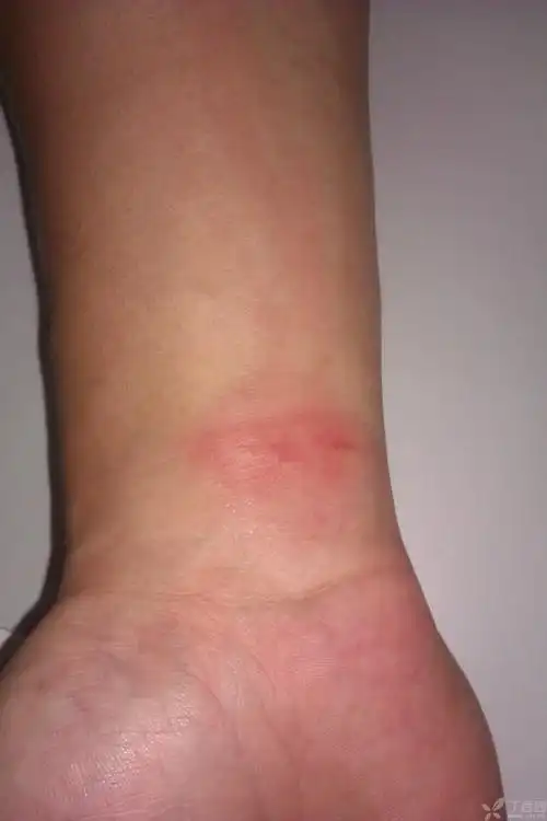 男,29岁,诉虫咬后右手腕上方出现红疹,不痒,伴疼痛,考虑为虫咬皮炎