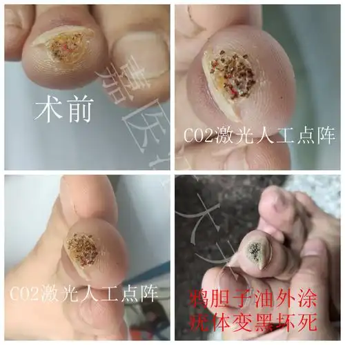 co2点阵激光结合中药治疗病毒疣