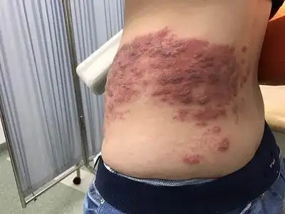 腰上长这么多水疱,是"缠腰龙"吗?