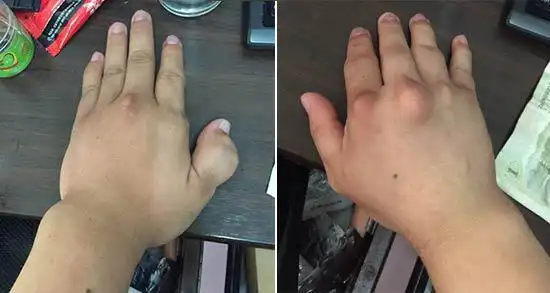 (治疗前:手部关节曾多处出现痛风石,且痛风石体积较大)