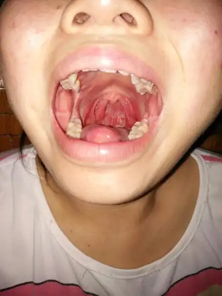 喉咙长得东西好像滤泡咽喉炎,干痒,咳嗽.