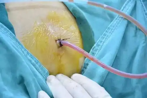 武宣首例单孔微创保胆取石手术在中医院顺利完成