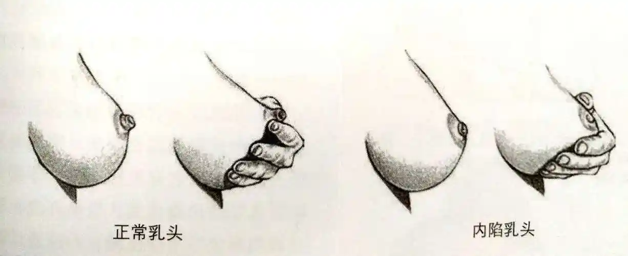 乳头内陷的你如何做能正常哺乳
