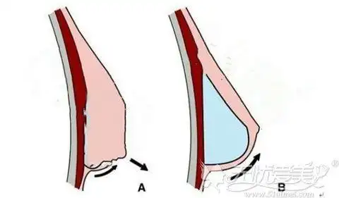 胸下垂做乳房悬吊术有疤痕吗术后效果能维持多久