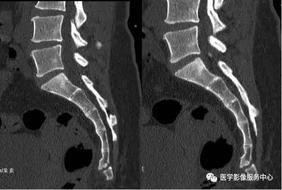 附病例(x线 ct):另外,骶尾骨骨折,特别是尾椎脱位的诊断还要和临床